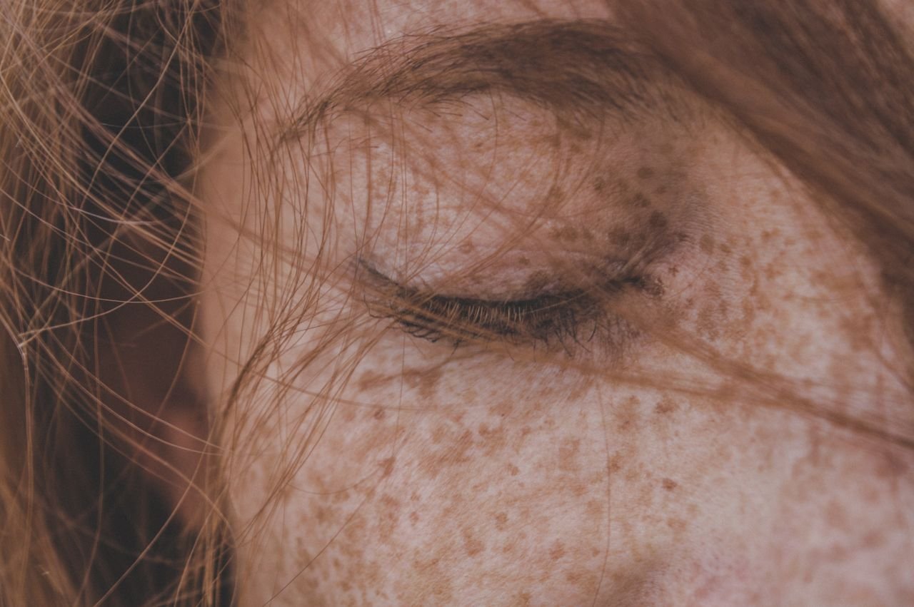 Cosmetic Freckles at Sol Lux Beauty Beverly Hills